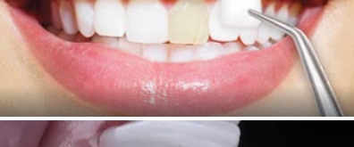 Prosthodontics & Cosmetic Ceramic Veneers at Cédar Dentistry